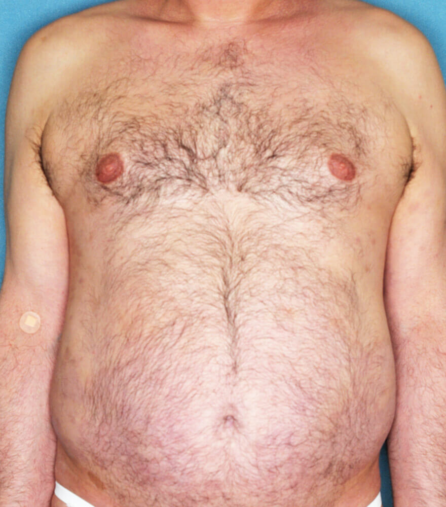 Psoriasis patient photos 28% BSA before vs 0% BSA after 3 months with SILIQ