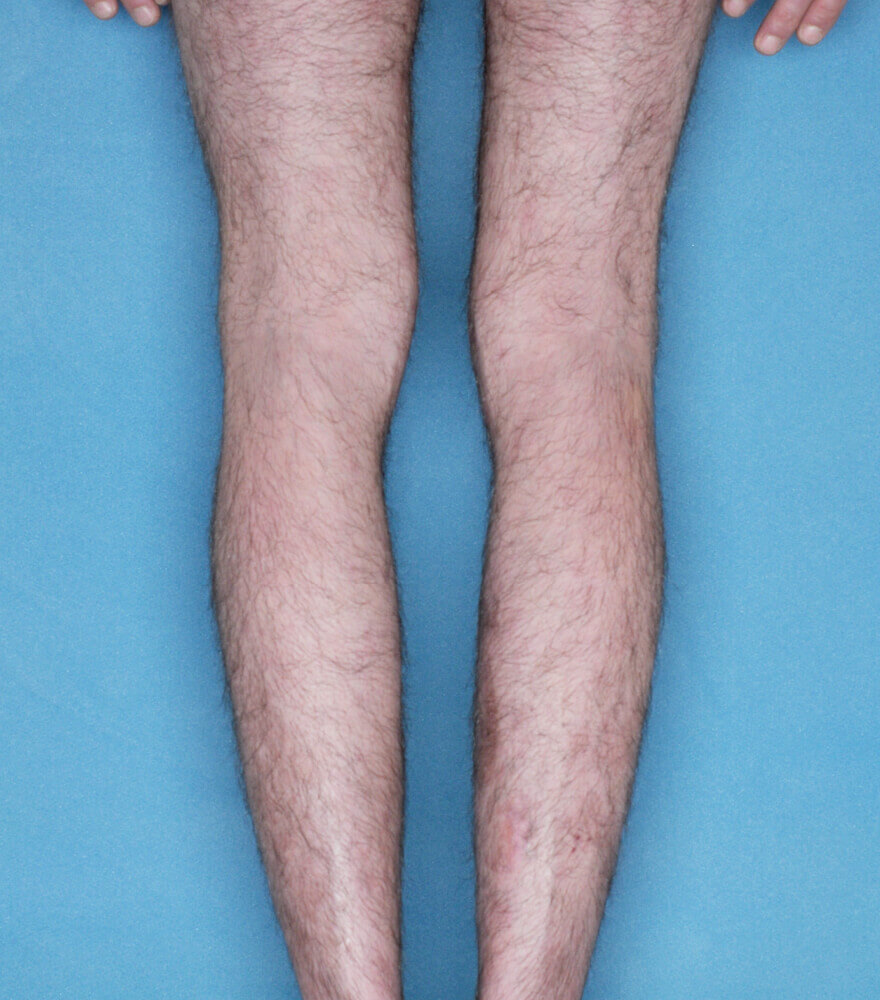 Psoriasis patient photos 30% BSA before vs 0% BSA after 3 months with SILIQ